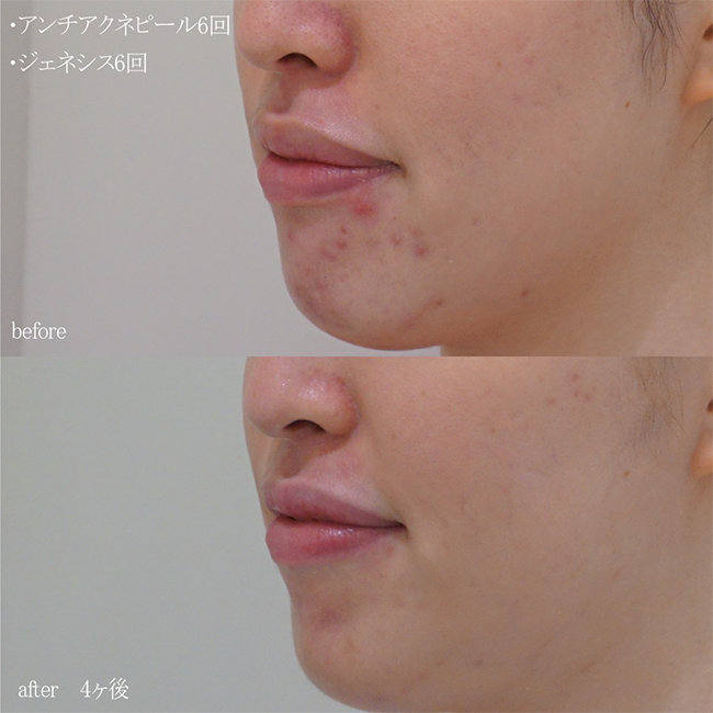 画像：ピーリング治療を受けた患者様の症例画像