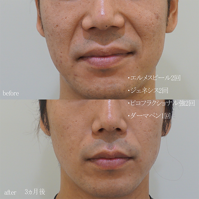 画像：実際に当院で毛穴治療を受けた患者様の症例画像