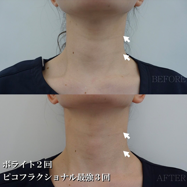 画像：首のシワにお悩みの患者様