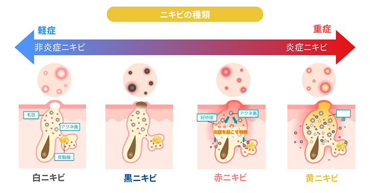 イラスト：ニキビの種類