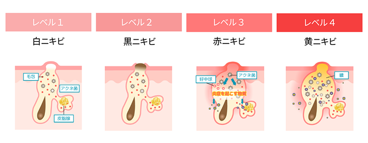 イラスト：ニキビの種類
