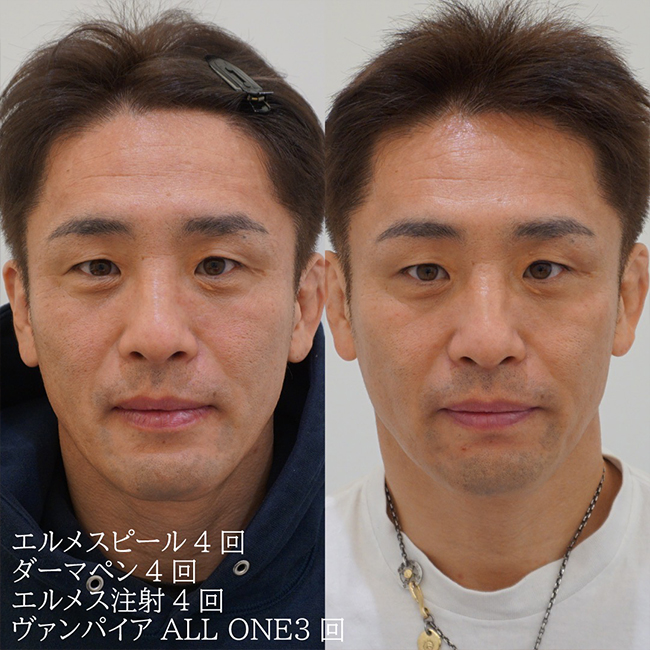 画像：目の下のシミ（老人性色素班）でお悩みの患者様