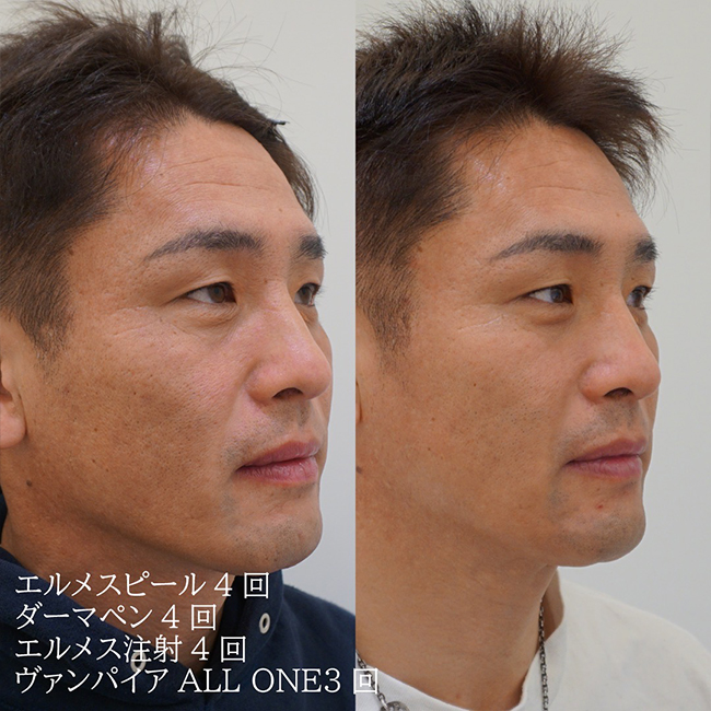 画像：目の下のシミ（老人性色素班）でお悩みの患者様