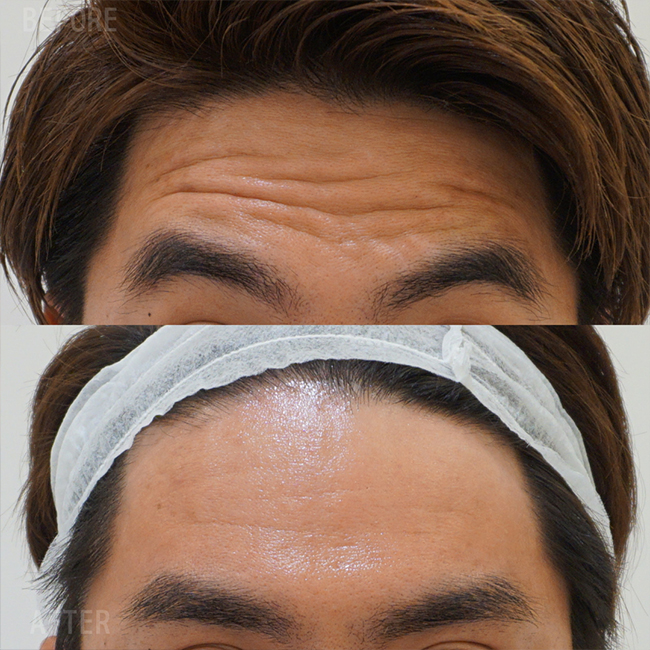 画像：老け顔（シワ）でお悩みの患者様